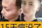 痘痘的克星