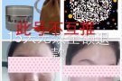 苗家秘制祛痘膏祛痘承诺十五天无效退款