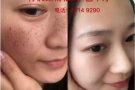 永久祛斑——- 1次见效！