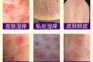 马来膏，马来西亚鹰阁医院研发纯中药膏，治疗脚气，湿疹，痱子，蚊虫叮咬，皮炎。 