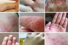 强效皮肤止痒杀菌膏
