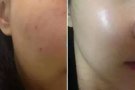 水光除皱抗衰提升