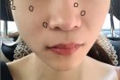 去痣|激光点痣| 1颗 脂肪粒 各种色素痣