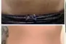 皺紋与妊娠紋