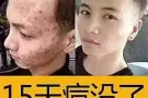 痘痘的克星