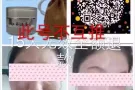 苗家秘制祛痘膏祛痘承诺十五天无效退款
