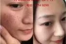 永久祛斑——- 1次见效！