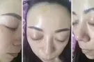 韩国水光针，保证一次见效