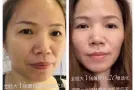 新加坡正规整形老店👩💃 🏥 81萾YlNG国际贸易 💉医疗美容抗衰减肥 