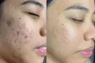 痘痘的克星
