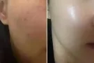 水光除皱抗衰提升