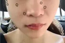 去痣|激光点痣| 1颗 脂肪粒 各种色素痣