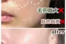 丽丝塔小金盒水光中的爱马仕！专业机打水光针！