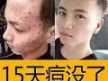 痘痘的剋星