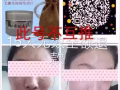 苗家秘制祛痘膏祛痘承诺十五天无效退款