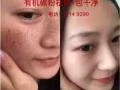 永久祛斑——- 1次见效！