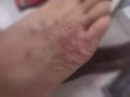 脚气病的克星
