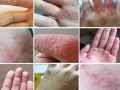 強效皮膚止癢殺菌膏