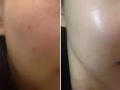 水光除皱抗衰提升