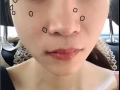 去痣|激光点痣| 1颗 脂肪粒 各种色素痣