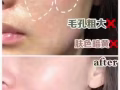 专业机打水光针！无效不收费！价格优惠！